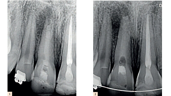 Traitement d’une incisive centrale non vitale avec un apex ouvert, en utilisant un matériel de réparation novateur à base de MTA