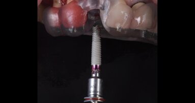 Workflow digitale nella protesizzazione immediata di un impianto abutment free