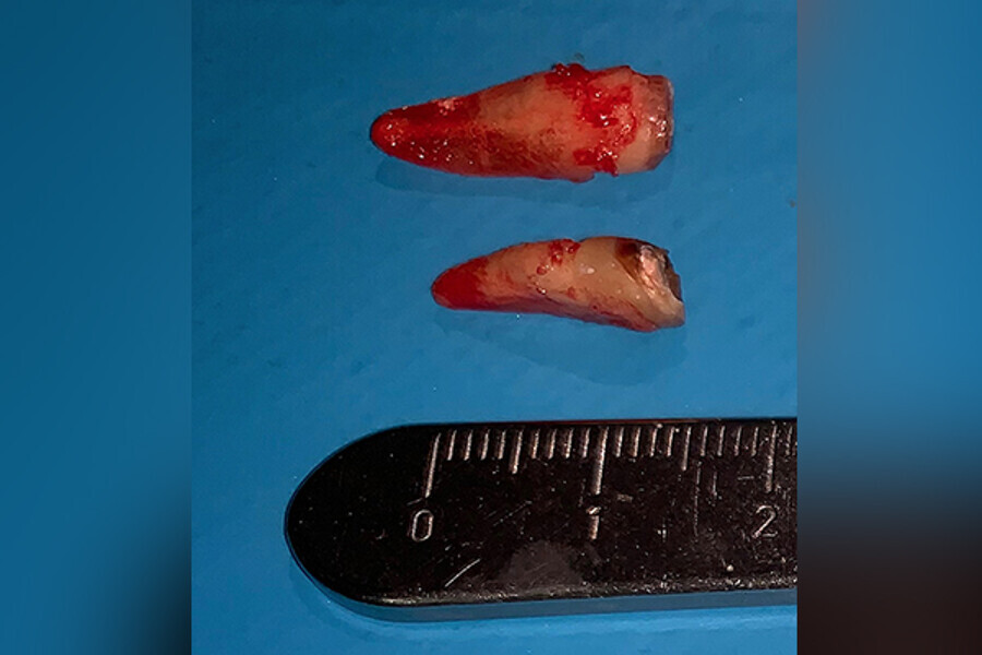 Figs. 8. Remoción delicada de los restos radiculares y comproba