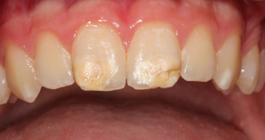 Prevalence of MIH exceeds that of dental caries among children in Germany