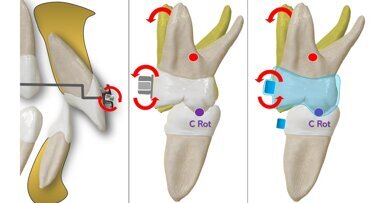 Alineadores: Biomecánica básica de los Ataches (2ª Parte)