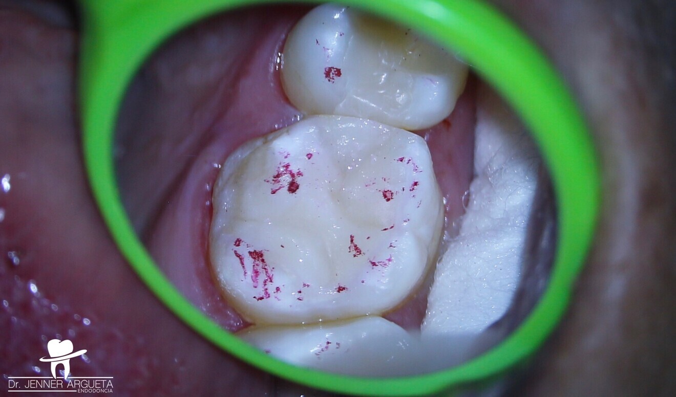 Fig. 7: Definitive adhesive restoration in tooth #16.