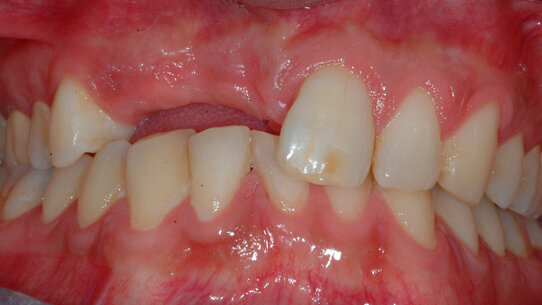 Espansione di cresta alveolare atrofica con strumentazione sonica senza lembo: tecnica FARE (Flapless Alveolar Ridge Expansion)