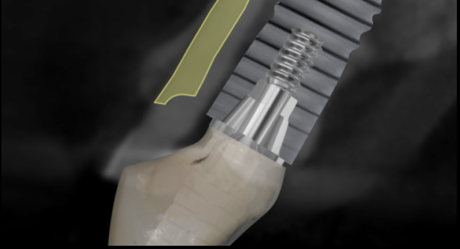 Udatta Kher socket shield 3