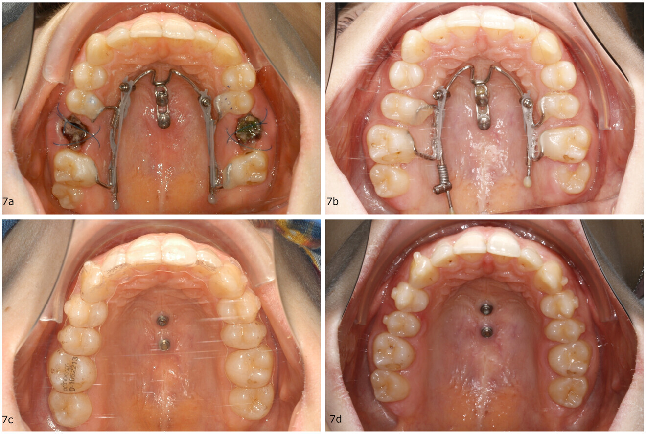 Figs. 7a–d: Treatment progress of a 22-year-old female patient with extracted maxillary first molars. (a) Mesialslider in place after extraction of upper first molars. (b) Situation after ten months. (c) Subsequent aligner finishing. (d) Result.
