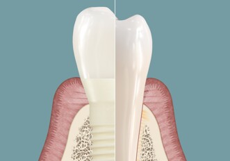 Patent Symbionic Teeth