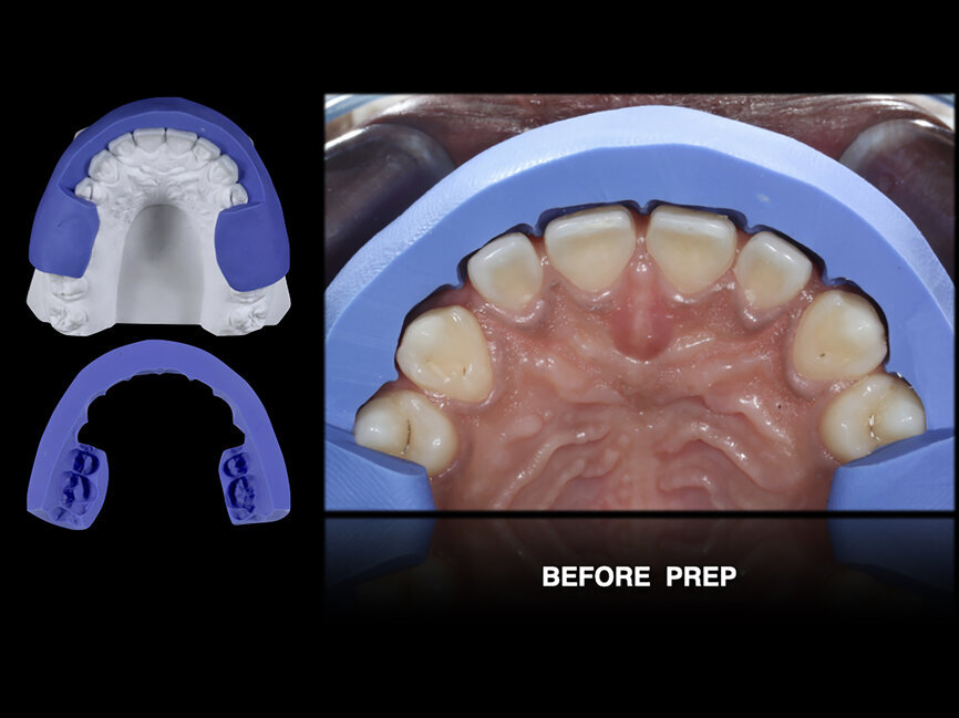 Fig. 56: Silicone index used to check facial reduction.