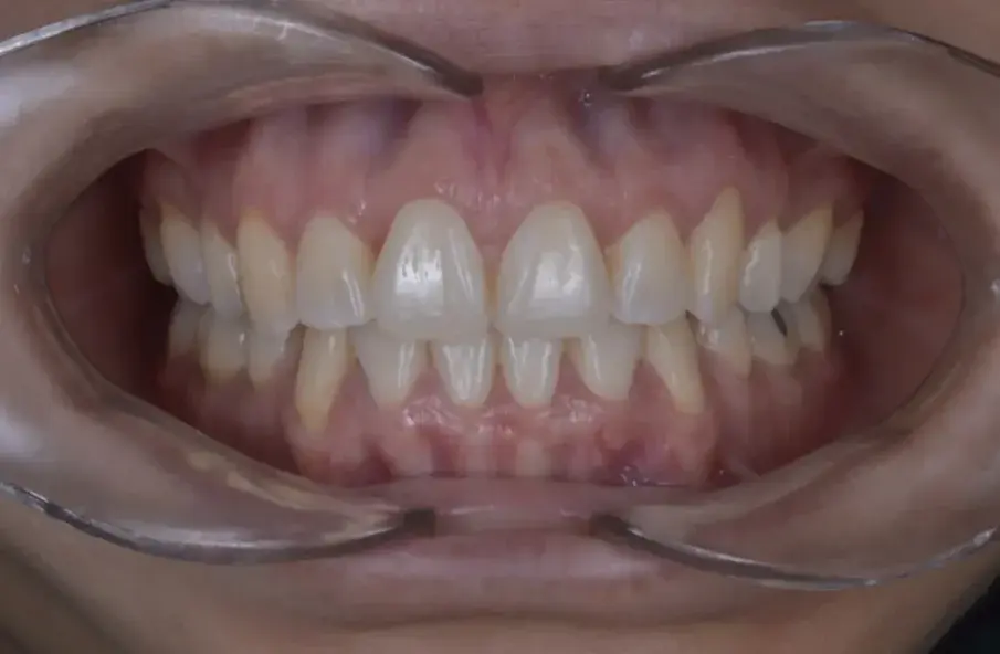 Фиг. 7а: Окончателни интраорални снимки.