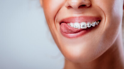 Zahnspange soll bei Gewichtsreduktion helfen Zahnspange soll bei Gewichtsreduktion helfen