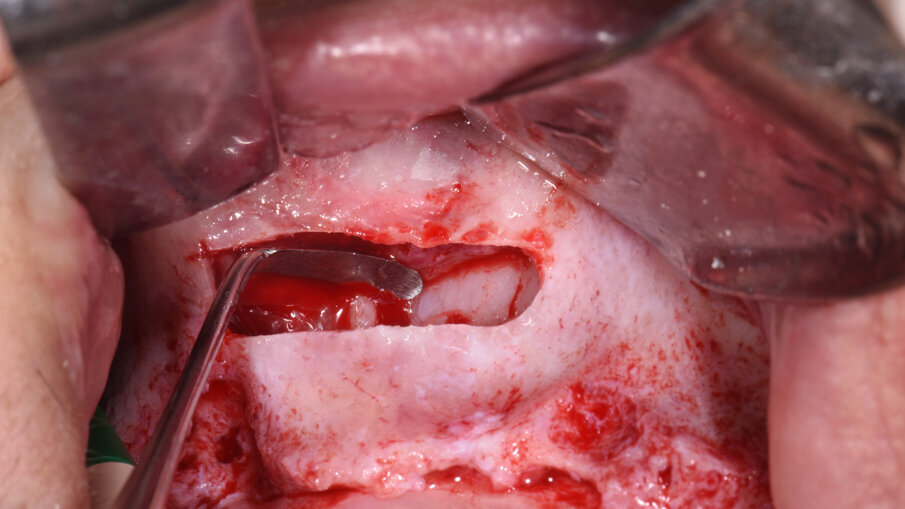 Obr. 4: Elevace Schneiderovy membrány.