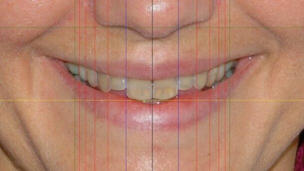 Projektowanie uśmiechu na podstawie zdjęcia twarzy