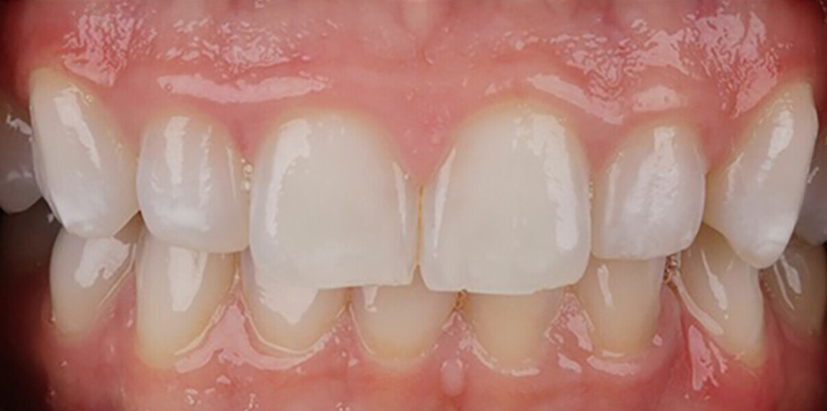 Fig. 5b: Fourteen-month follow-up. Note the colour stability after 14 months.