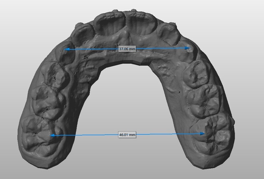 Fig. 12b: Maxillary arch size analysis at the (a) start and (b) end of treatment.