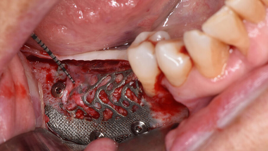 Figg. 9a-9c_Foto intra-operatoria durante la rimozione della griglia in titanio che evidenzia l’incremento osseo ottenuto e l’assenza di perdita ossea al di sotto della griglia.