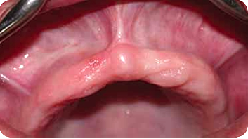 Reconstrucción ósea del máxilar atrófico