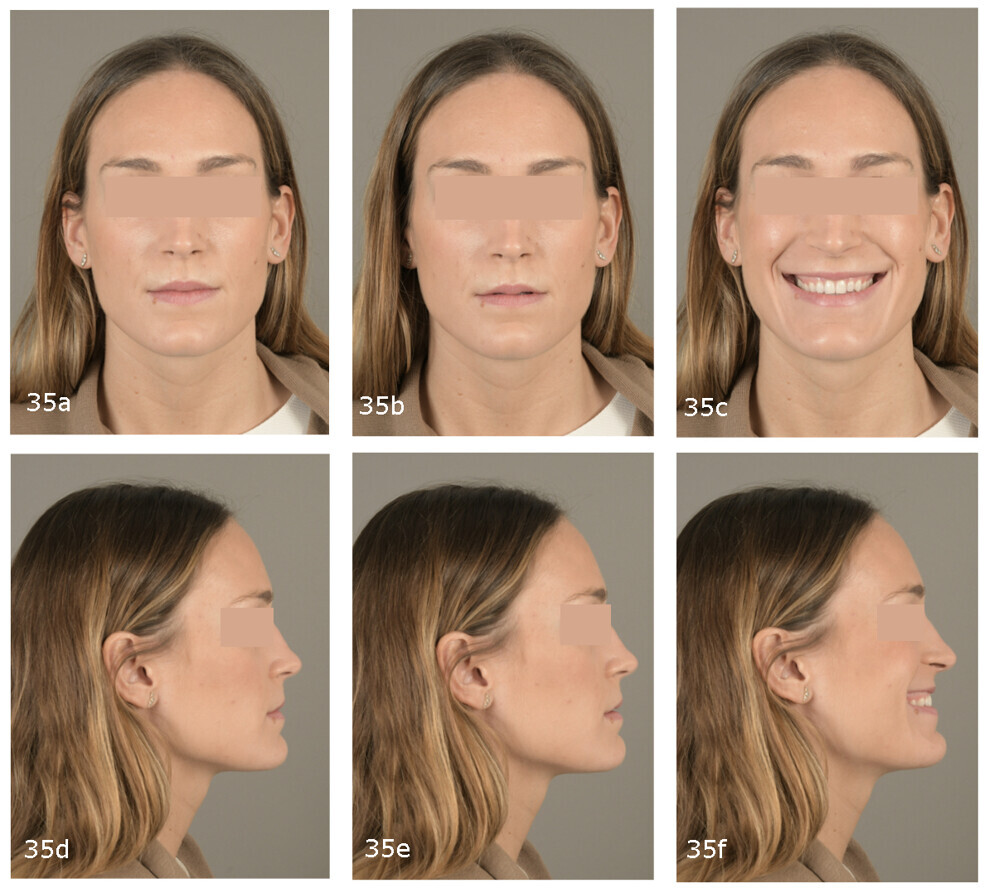 Figs. 35a–f: Pretreatment extra-oral photographs.