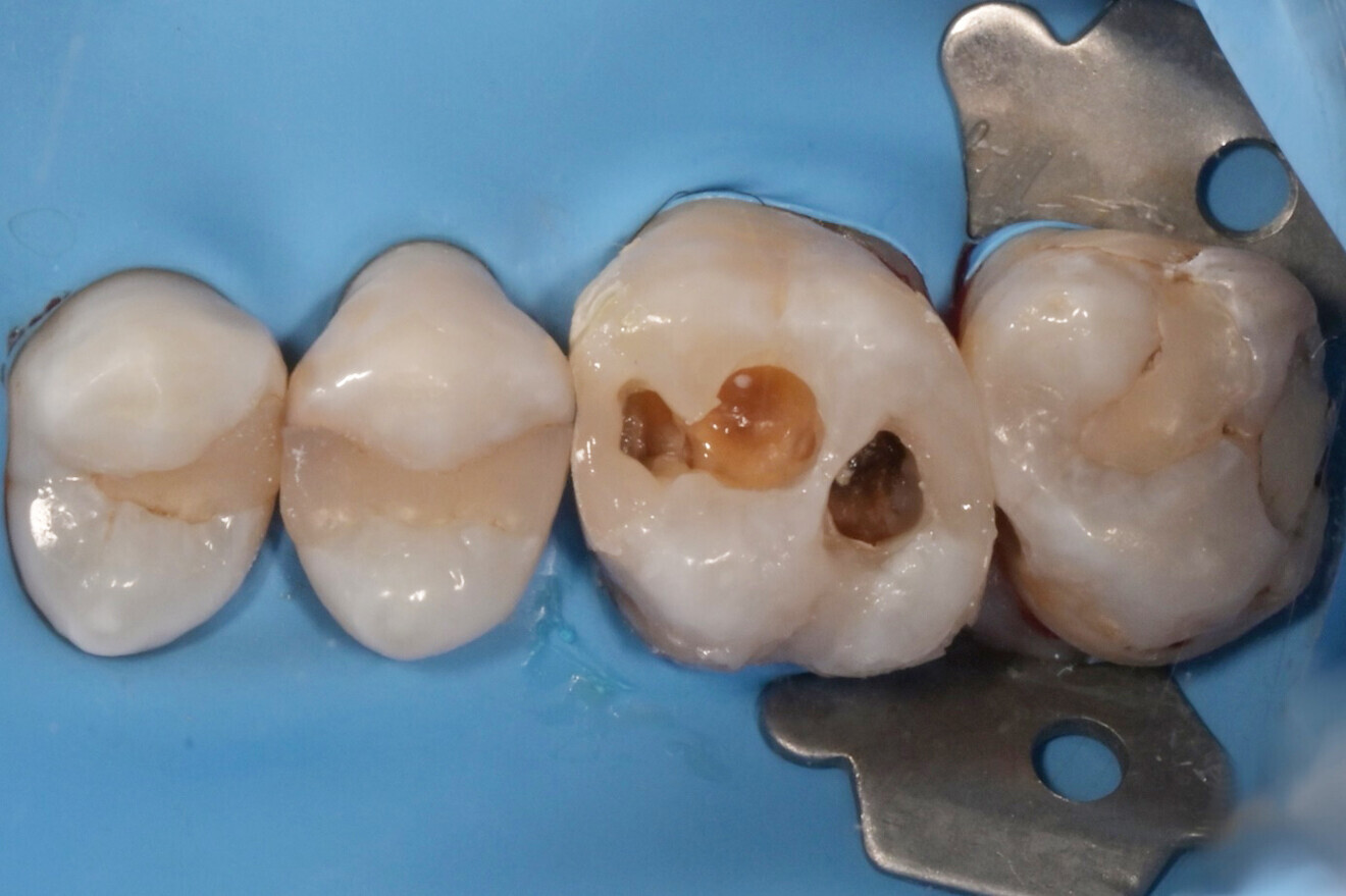 Фиг. 3: Възстановяване на апроксималните стени с композитен материал. 