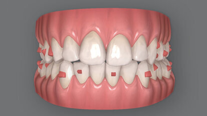 Traitement orthodontique par aligneurs transparents d’une malocclusion complexe