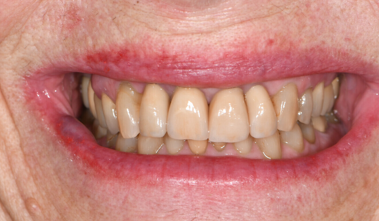 Fig. 13: Immediate treatment outcome, facial view.