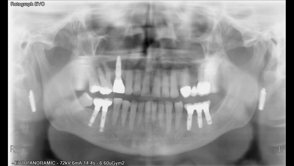 Míra úspěšnosti dentálních implantátů u těžkých kuřáků. Dlouhodobá studie