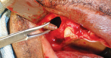 Implants displaced into the maxillary sinus