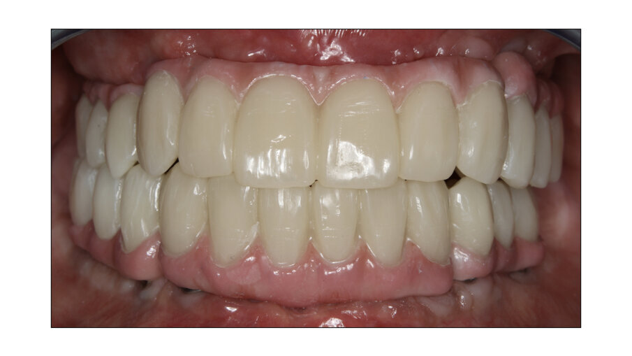 Fig. 8: Upper and lower bridges in the mouth.