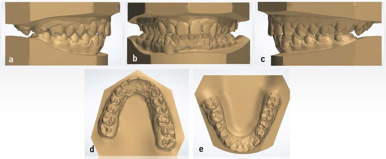 Figs. 17a–e: Digital models taken after the orthodontic treatment (images generated using 3Shape Dental System).