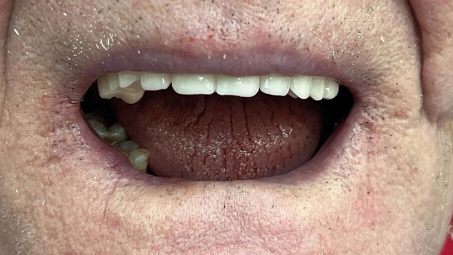 Fig. 12 - Inserimento provvisori - vista frontale.