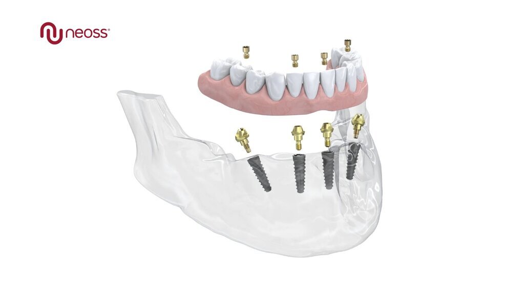 Neoss Group annuncia il lancio del Multi-Unit Abutment: la soluzione di trattamento Neoss4+ per arcate complete