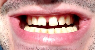 Czy diastema dodaje atrakcyjności?