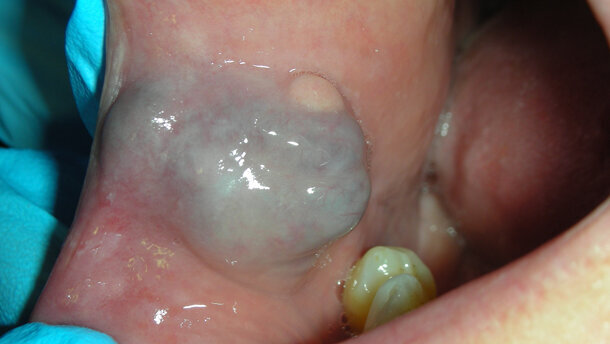 Il trattamento micro-invasivo degli emangiomi orali effettuato con laser a diodi: due case report