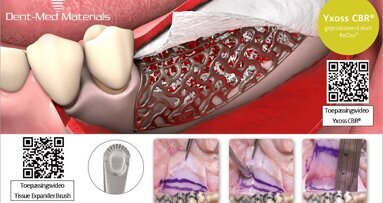 Complexe botdefecten, weefseltoename en spanningsvrij hechten