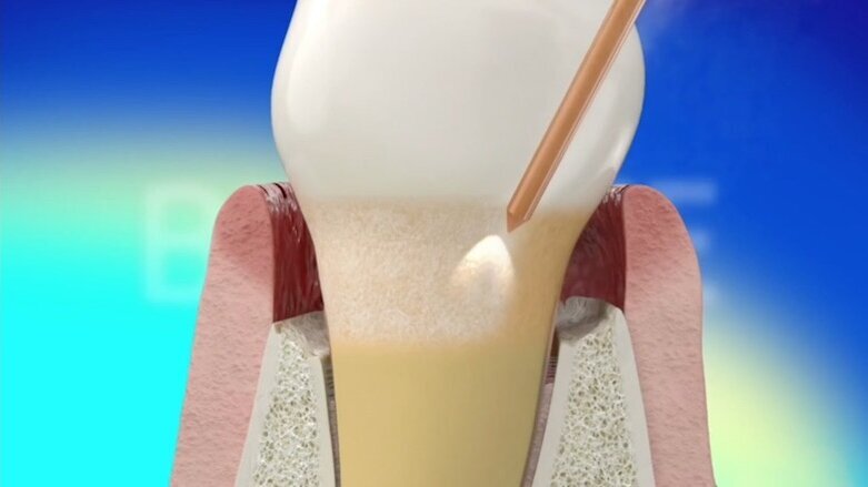 BIOLASE REPAIR Perio protocol shows superior results in study