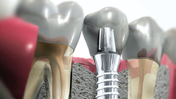 Cursos de implantología en la Cayetano Heredia