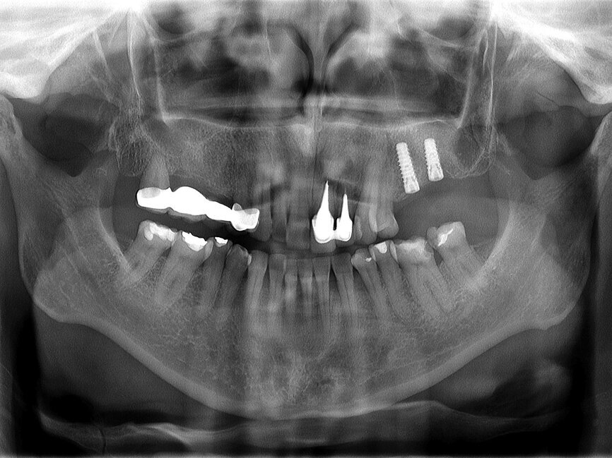 Fig. 11: Panoramic finding after six months of uneventful healing.