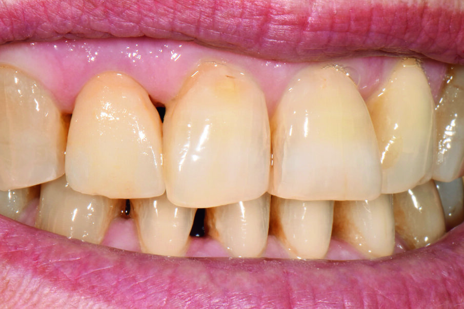 Fig. 5: After the stain firing, all participants were satisfied with the result.