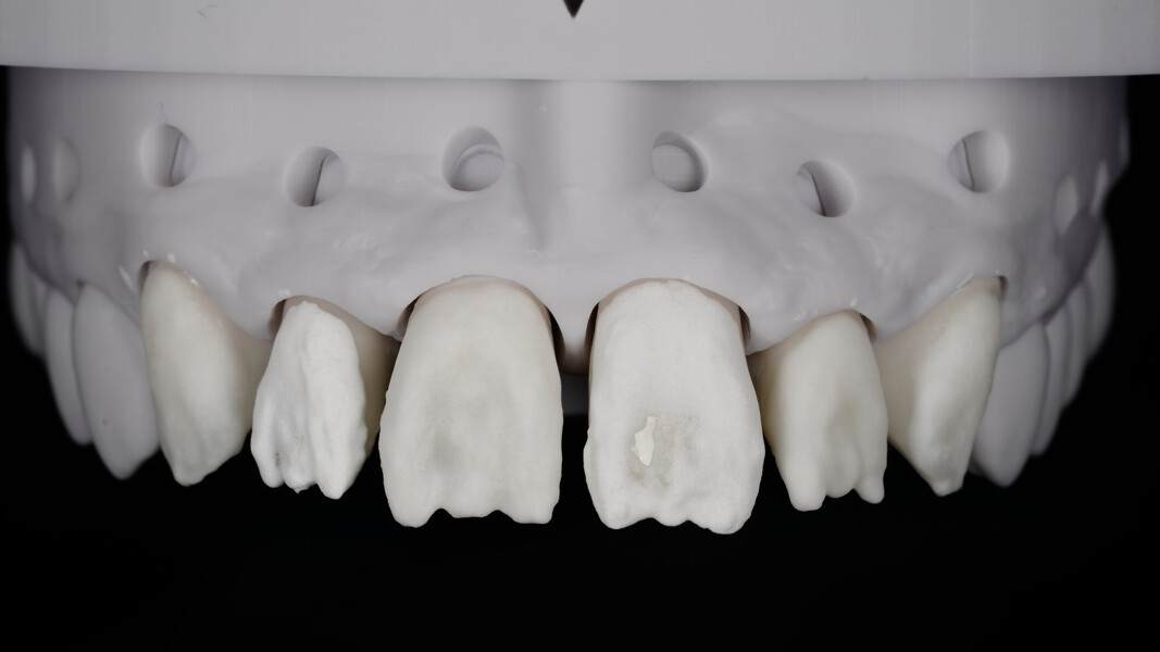 Fig. 14: Opacity control using CERABIEN ZR Opacious Body in Shade OB White to optimise brightness.