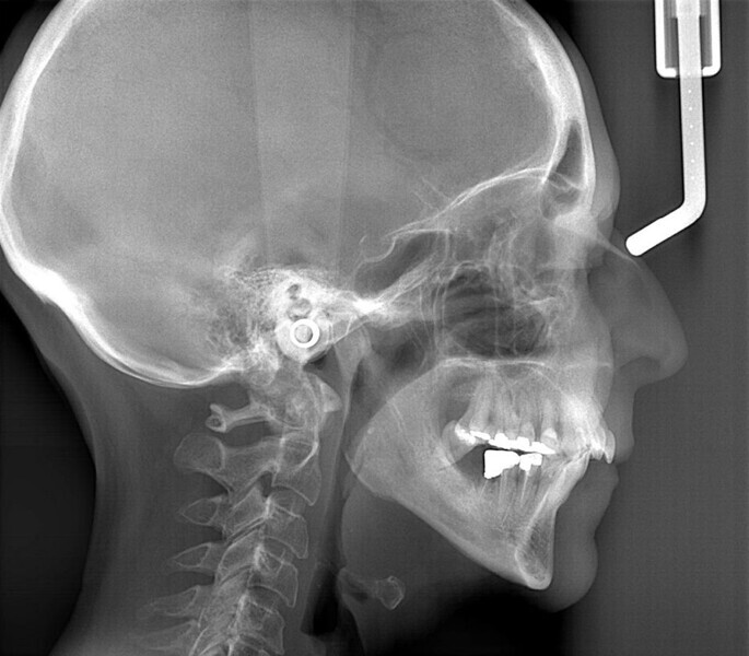 Fig. 6: Cephalometric radiograph.