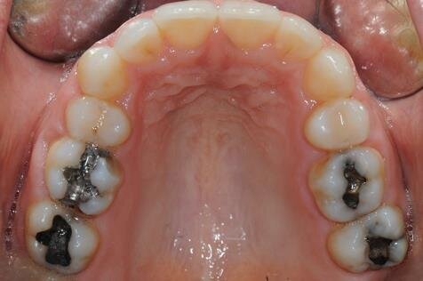 Figg. 6a-6d - Foto intraorali post-trattamento: visioni frontale (a), laterali (b), occlusali (c, d).