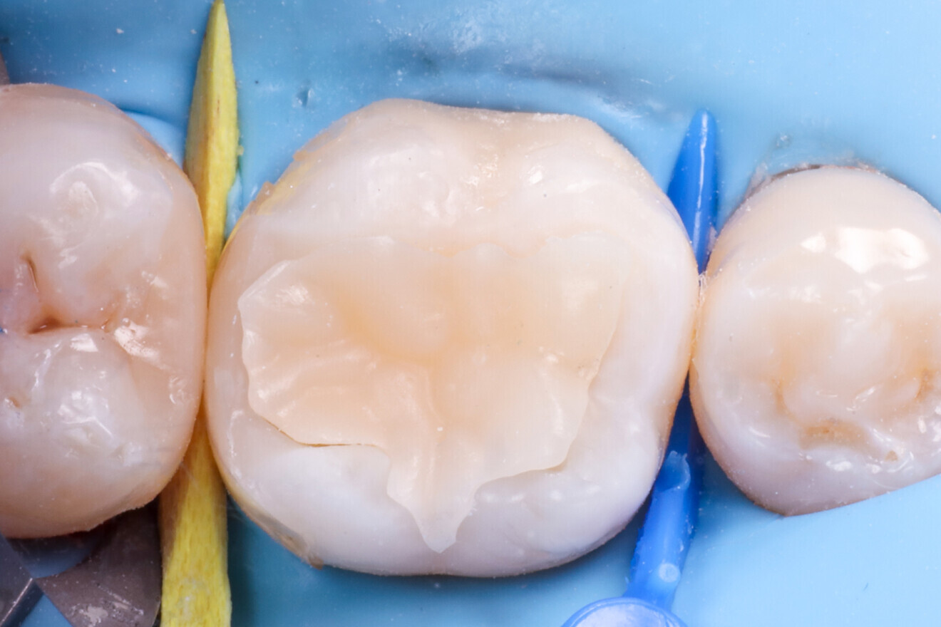 Fig. 22: Try-in of the semi-direct restoration.