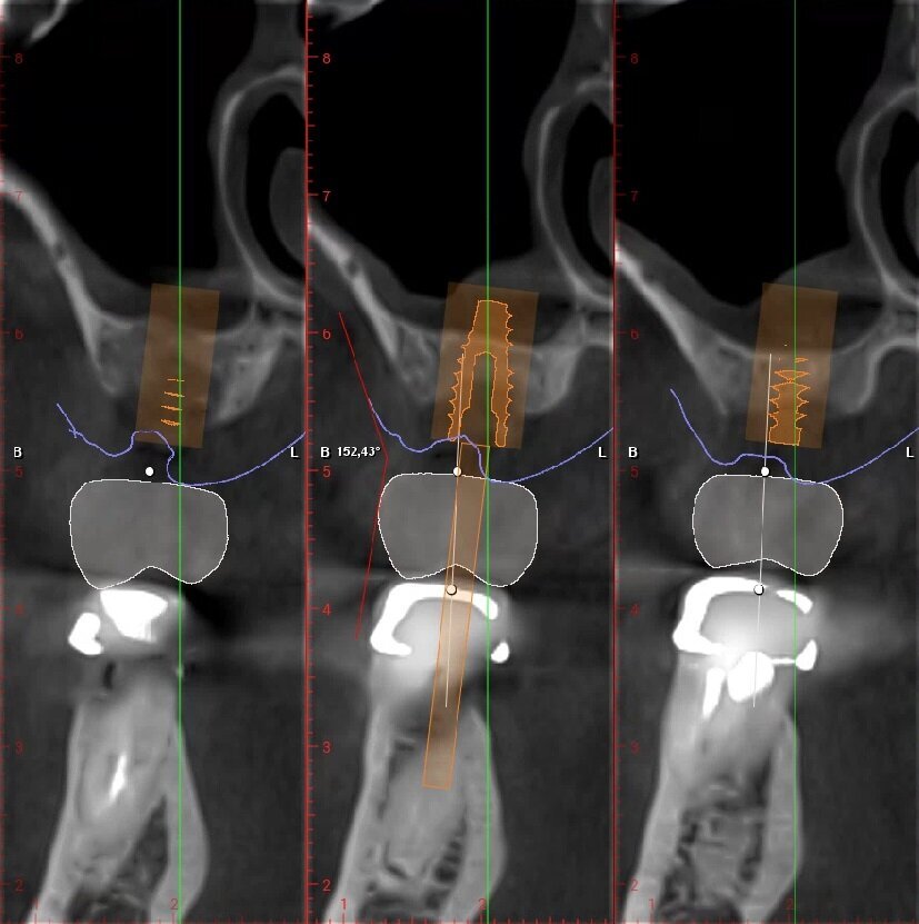 Fig. 9_Valutazione angolo di emergenza della protesi elemento 2.6, valore 152,43°.