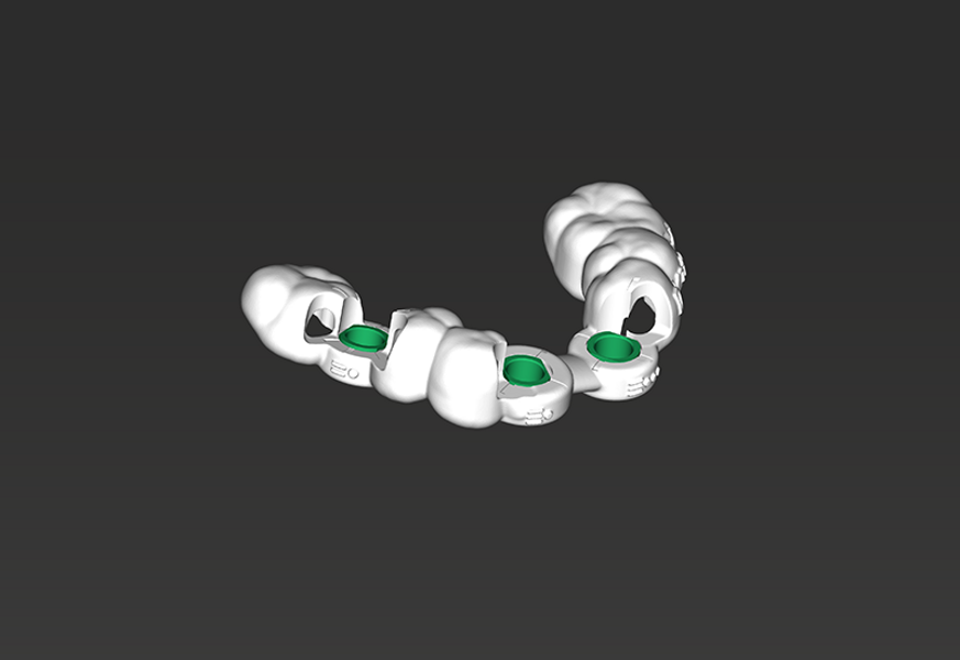 coDiagnostiX digital drill guide