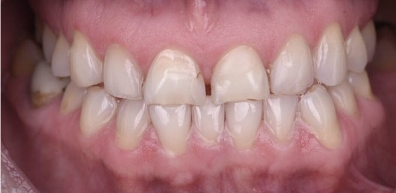 Fig. 10a: Pre-op intra-oral view.