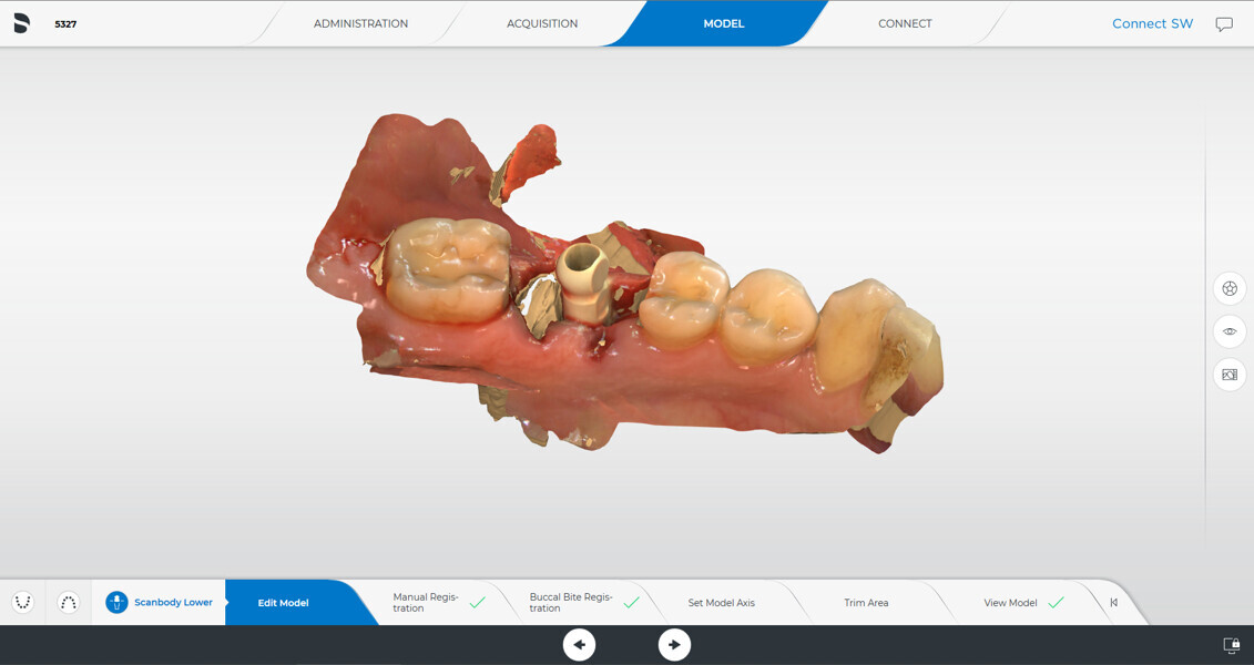 Fig. 6: Intra-oral scan with Primescan (Dentsply Sirona) immediately after implant placement. 