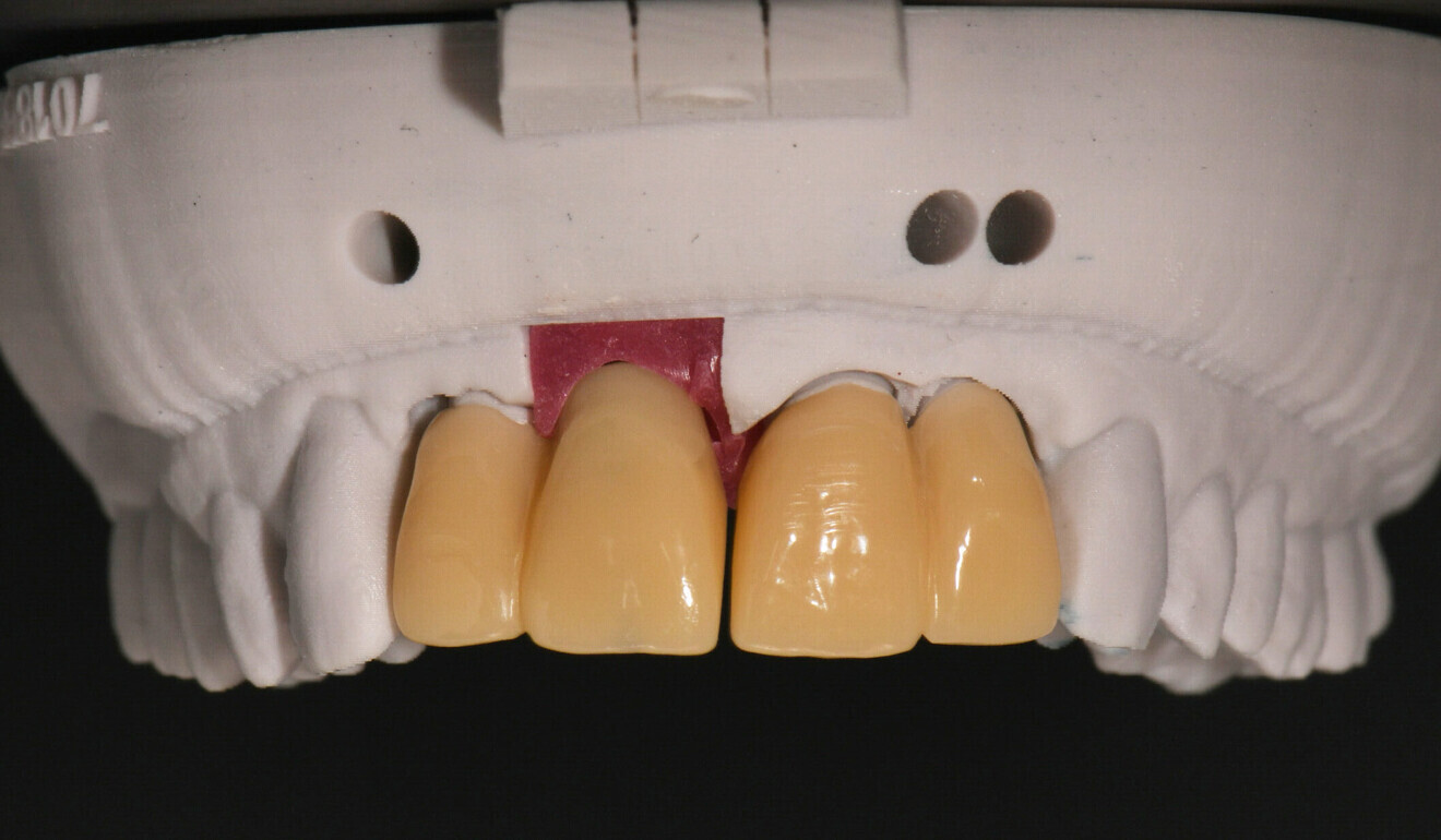 Fig. 6: Printed model with splinted PMMA crowns.