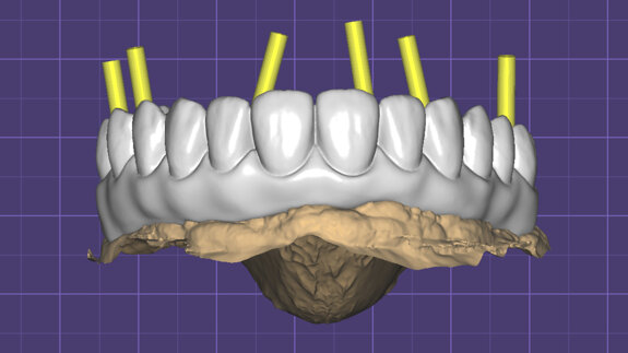Efficient production of a hybrid implant-supported full-arch prosthesis