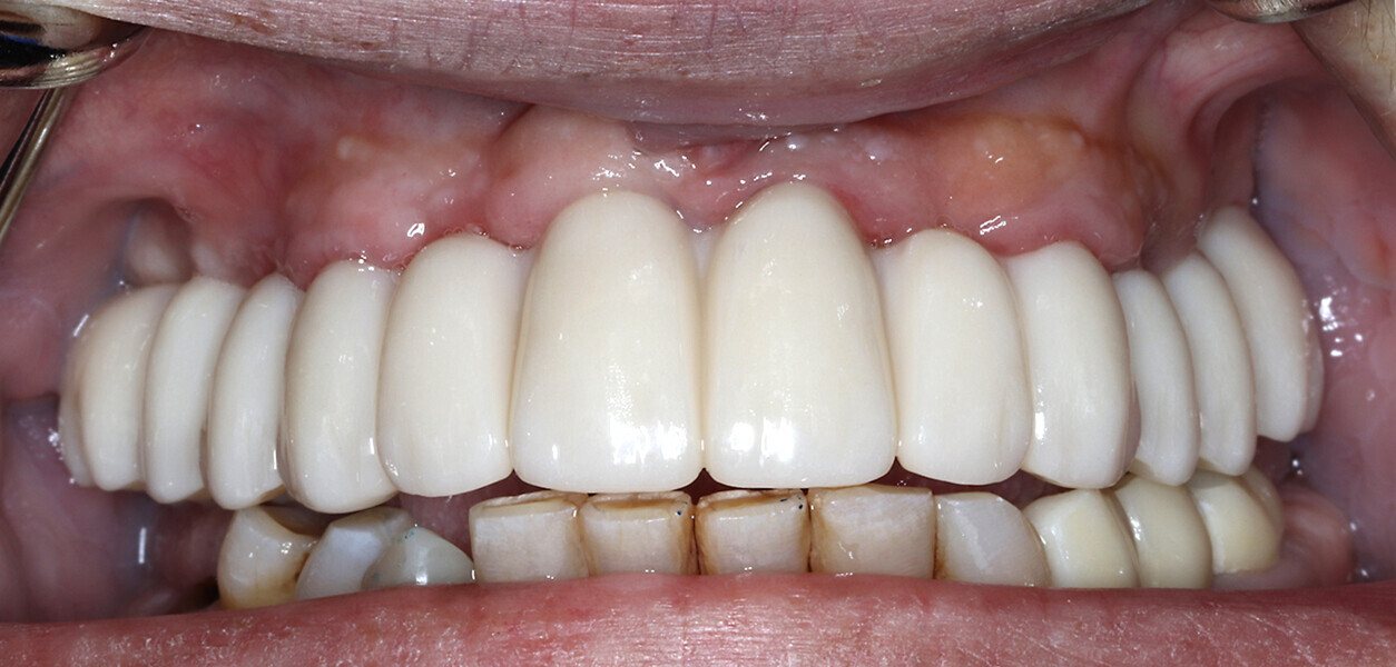 Fig. 5k: Final metal-free monolithic zirconia restoration secured with Powerball screws.