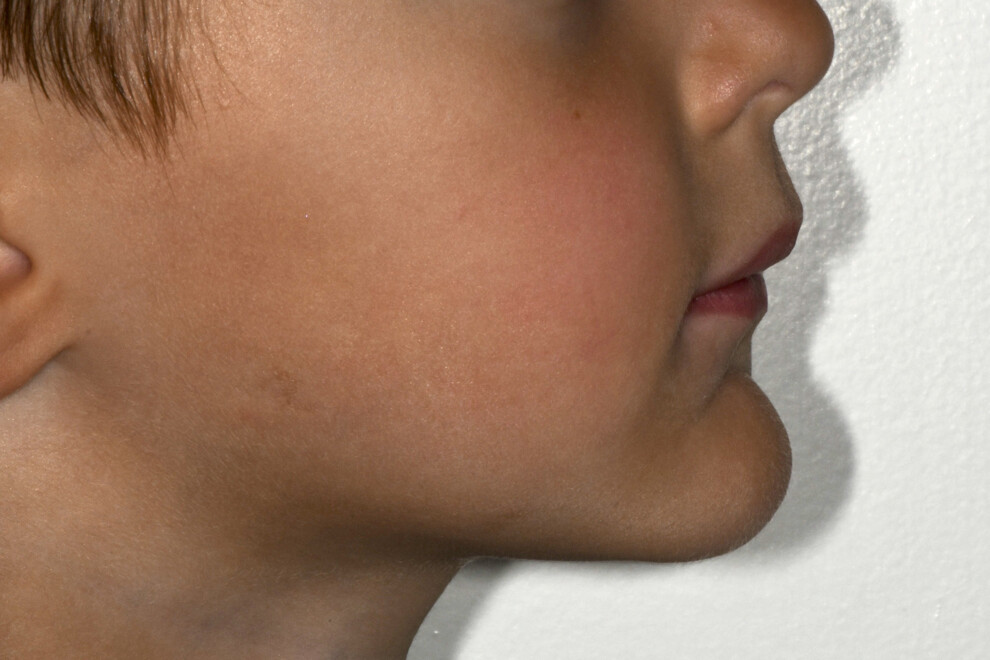 Fig. 9: Profile view after cementation.