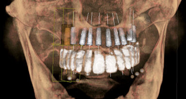 Vantaggi della progettazione implantare in 3D