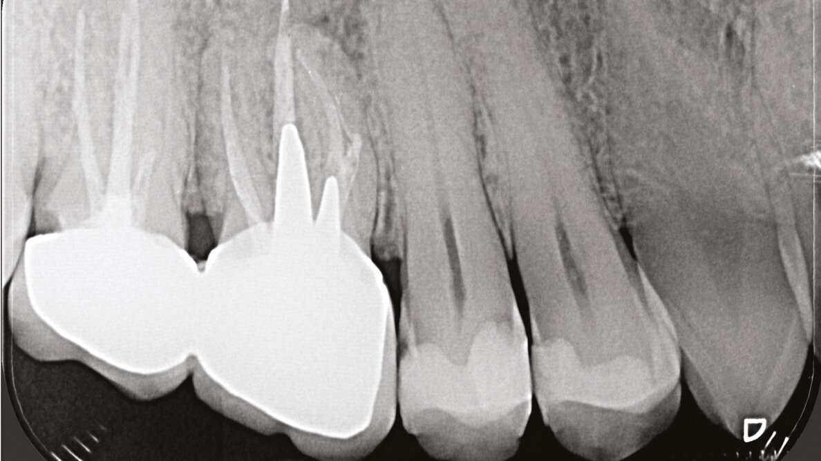 L’utilizzo della Cone Beam Computed Tomography (CBCT) in endodonzia clinica e chirurgica